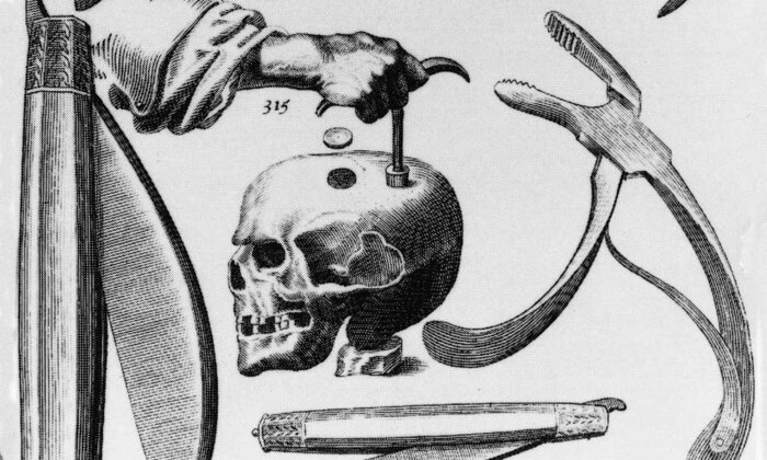 Read more about the article The Theories of Trepanning